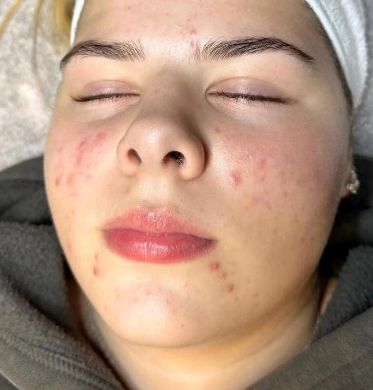 hormonal acne before and after microdermabrasion treatment SkinBase Bronze Inc 1