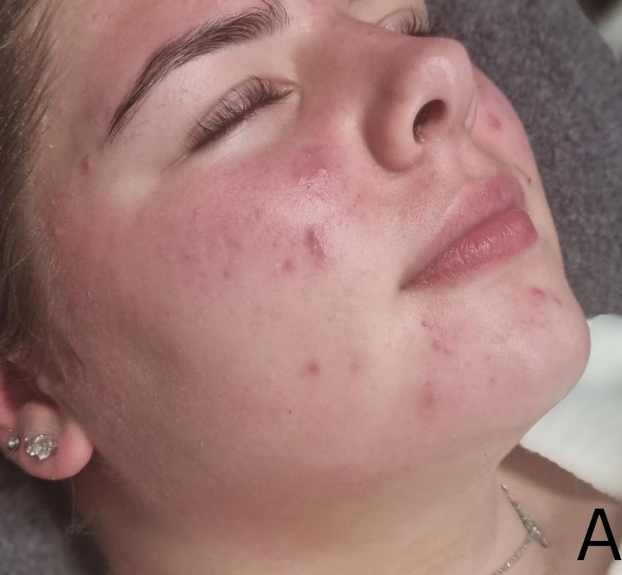 hormonal acne before and after microdermabrasion treatment SkinBase Bronze Inc 2