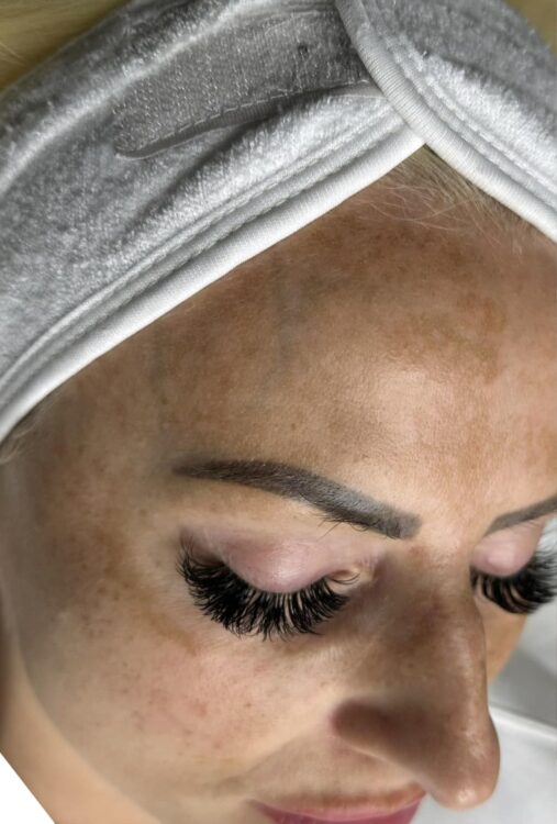 hormonal pigmentation treatment non-invasive before and after SkinBase Microdermabrasion Jenna Godfrey Aesthetics 1