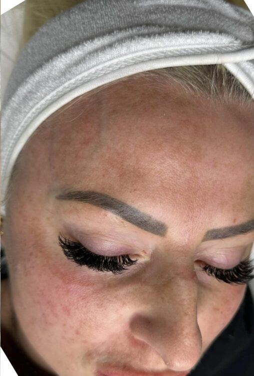 hormonal pigmentation treatment non-invasive before and after SkinBase Microdermabrasion Jenna Godfrey Aesthetics 2