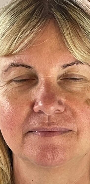 intense pulsed light fine lines and wrinkles treatment results SkinBase Bijou Beauty Room 1