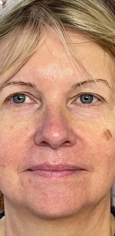 intense pulsed light fine lines and wrinkles treatment results SkinBase Bijou Beauty Room 2