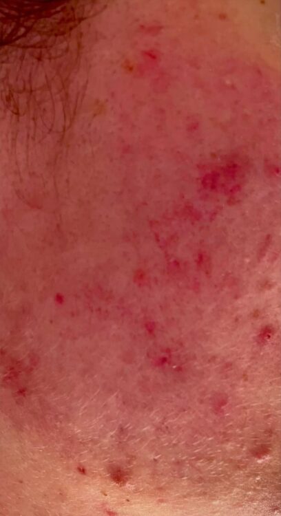 ipl and microdermabrasion for acne results SkinBase Bijou Beauty Room 1