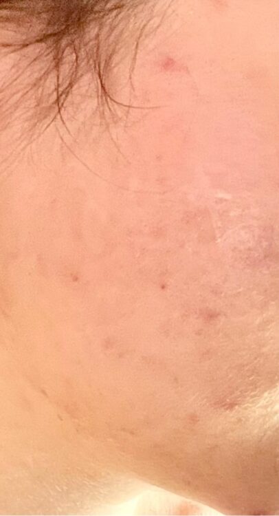 ipl and microdermabrasion for acne results SkinBase Bijou Beauty Room 2