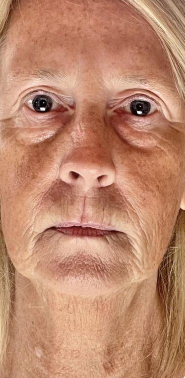 jawline and jowls rejuvenation SkinBase Collagen Lift Bijou Beauty Room 1