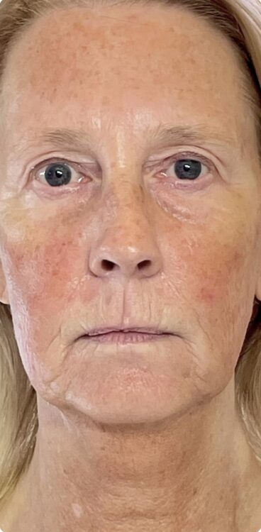 jawline and jowls rejuvenation SkinBase Collagen Lift Bijou Beauty Room 2