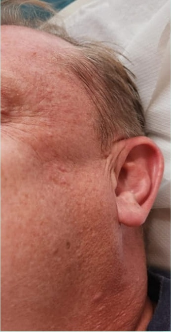male microdermabrasion results rough skin texture Bobbi Brooklyn Aesthetics Clinic 1