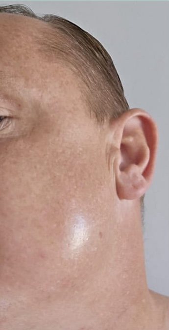 male microdermabrasion results rough skin texture Bobbi Brooklyn Aesthetics Clinic 2