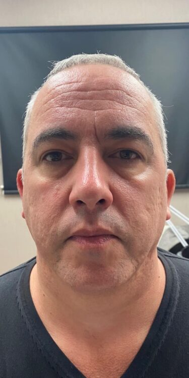 male radio-frequency treatment results Gaynor Louise Beauty & Aesthetics SkinBase Collagen Lift 1