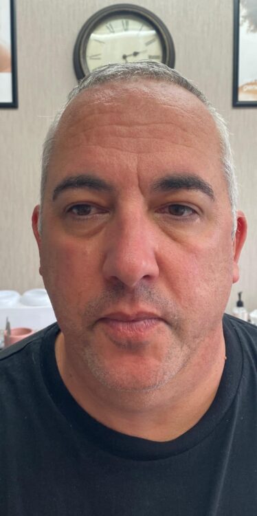 male radio-frequency treatment results Gaynor Louise Beauty & Aesthetics SkinBase Collagen Lift 2