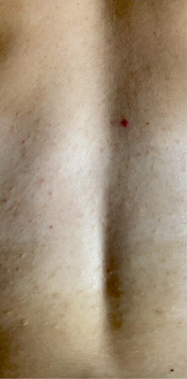 microdermabrasion acne back treatment results bijou beauty room 2