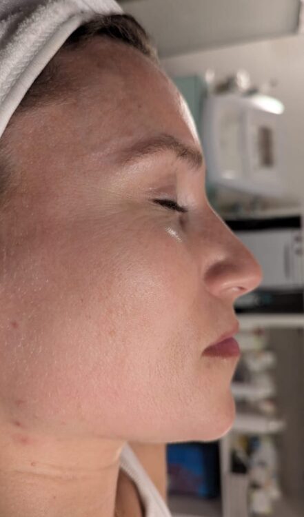 microdermabrasion for fine lines and wrinkles results Gaby Massage & Beauty 1