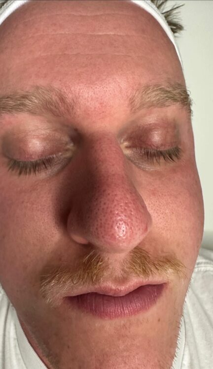microdermabrasion for men blackheads treatment Kingman Aesthetics 1