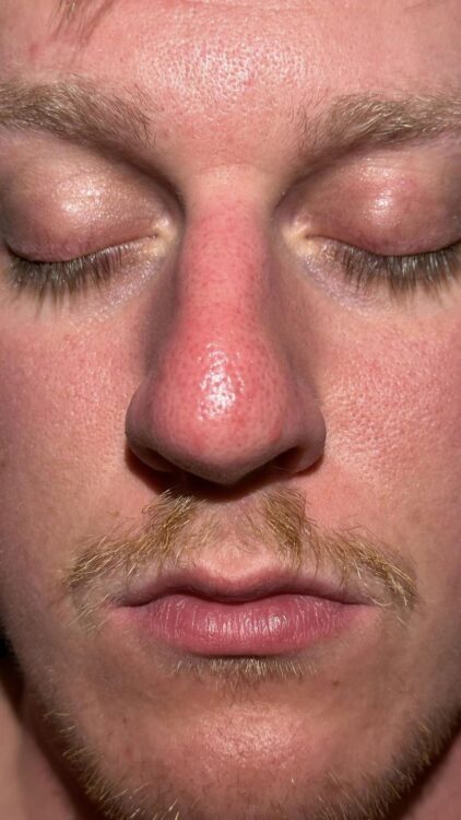 microdermabrasion for men blackheads treatment Kingman Aesthetics 2