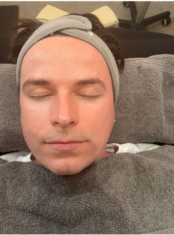 microdermabrasion for men results DV massage and skincare 1