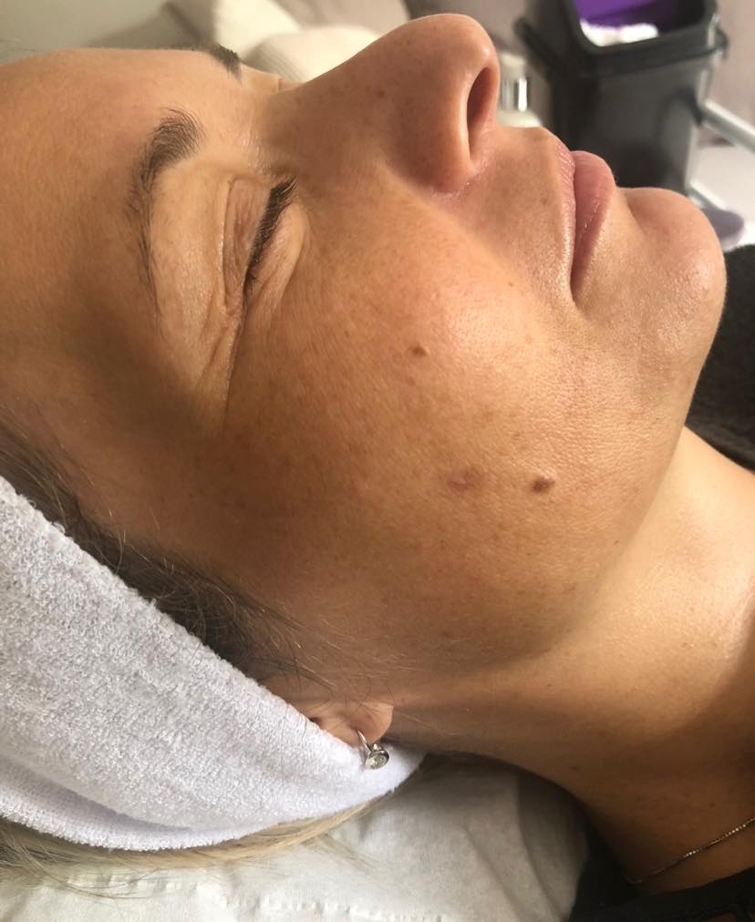 microdermabrasion for pigmentation before and after SkinBase The Blissful Beauty Company 1
