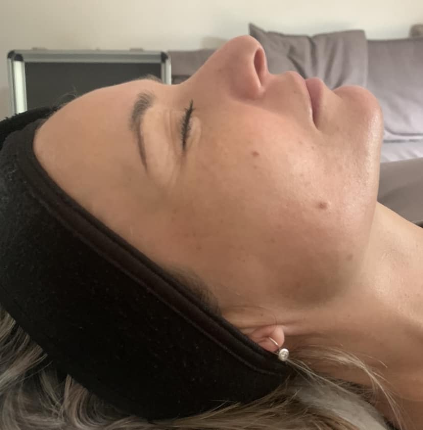 microdermabrasion for pigmentation before and after SkinBase The Blissful Beauty Company 2