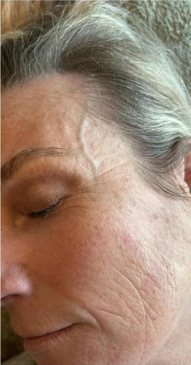 microdermabrasion for sun damaged skin before and after SkinBase BeaZen Beauty 1
