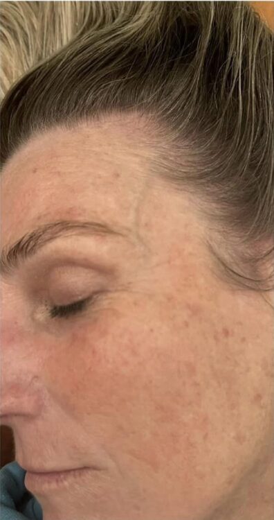 microdermabrasion for sun damaged skin before and after SkinBase BeaZen Beauty 2