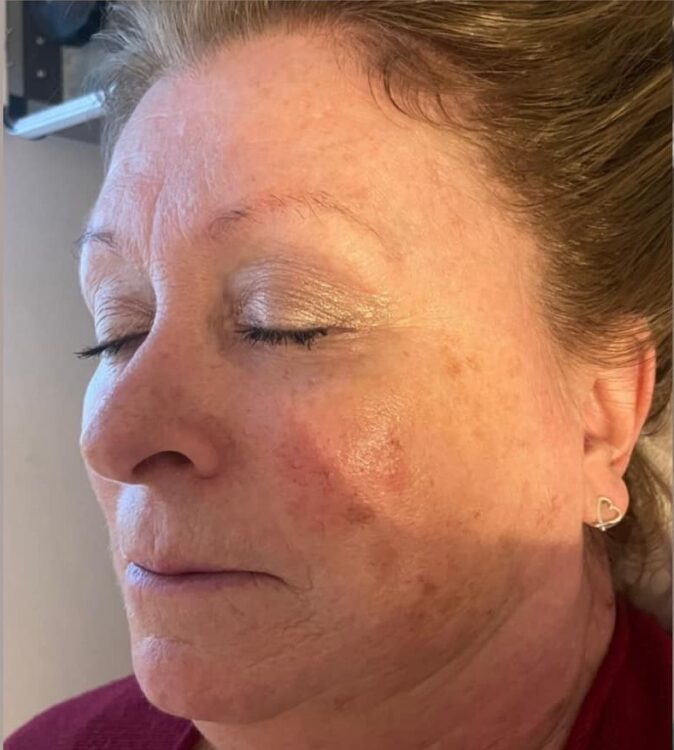 microdermabrasion pigmentation treatment before and after SkinBase Karen's Home Hairdressing 1