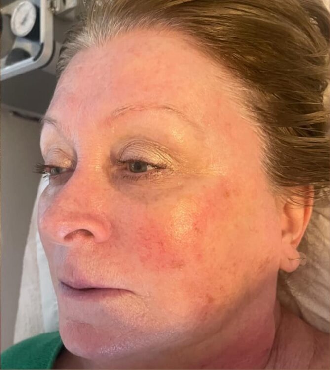 microdermabrasion pigmentation treatment before and after SkinBase Karen's Home Hairdressing 2