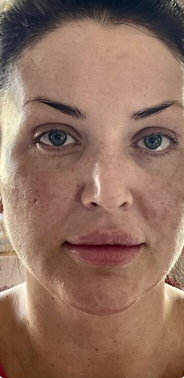 non invasive treatment to rejuvenate your complexion SkinBase IPL Bijou Beauty Room 1