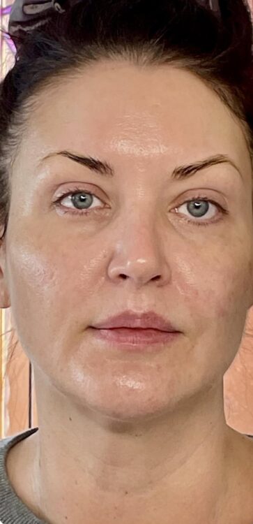 non invasive treatment to rejuvenate your complexion SkinBase IPL Bijou Beauty Room 2