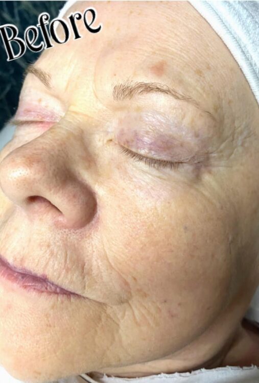 non-surgical anti-ageing facial before and after SkinBase IPL NB Nails Holistics Beauty 1