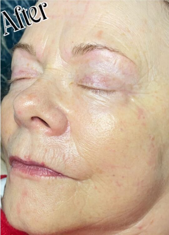 non-surgical anti-ageing facial before and after SkinBase IPL NB Nails Holistics Beauty 2