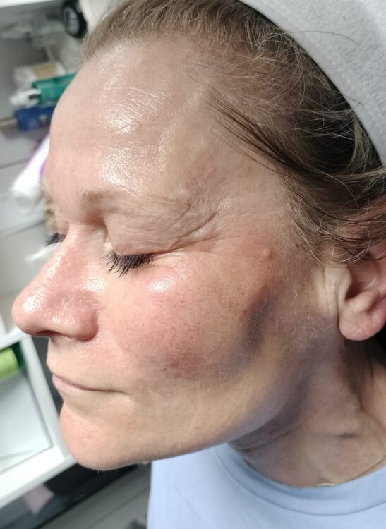 non-surgical facial resurfacing before and after SkinBase Microdermabrasion Natalie's Beauty & Spa 1