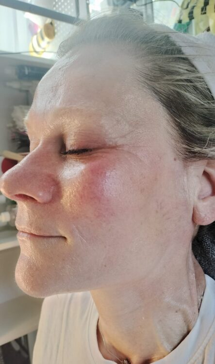 non-surgical facial resurfacing before and after SkinBase Microdermabrasion Natalie's Beauty & Spa 2