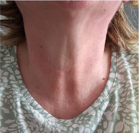 non-surgical neck rejuvenation treatment results SkinBase Collagen Lift Finishing Touches 1