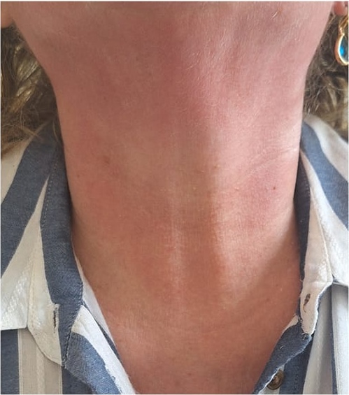 non-surgical neck rejuvenation treatment results SkinBase Collagen Lift Finishing Touches 2