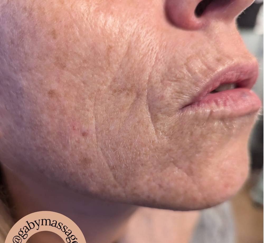 non-surgical radio frequency treatment for sun damaged skin results SkinBase Collagen Lift Gaby Massage and Beauty 1