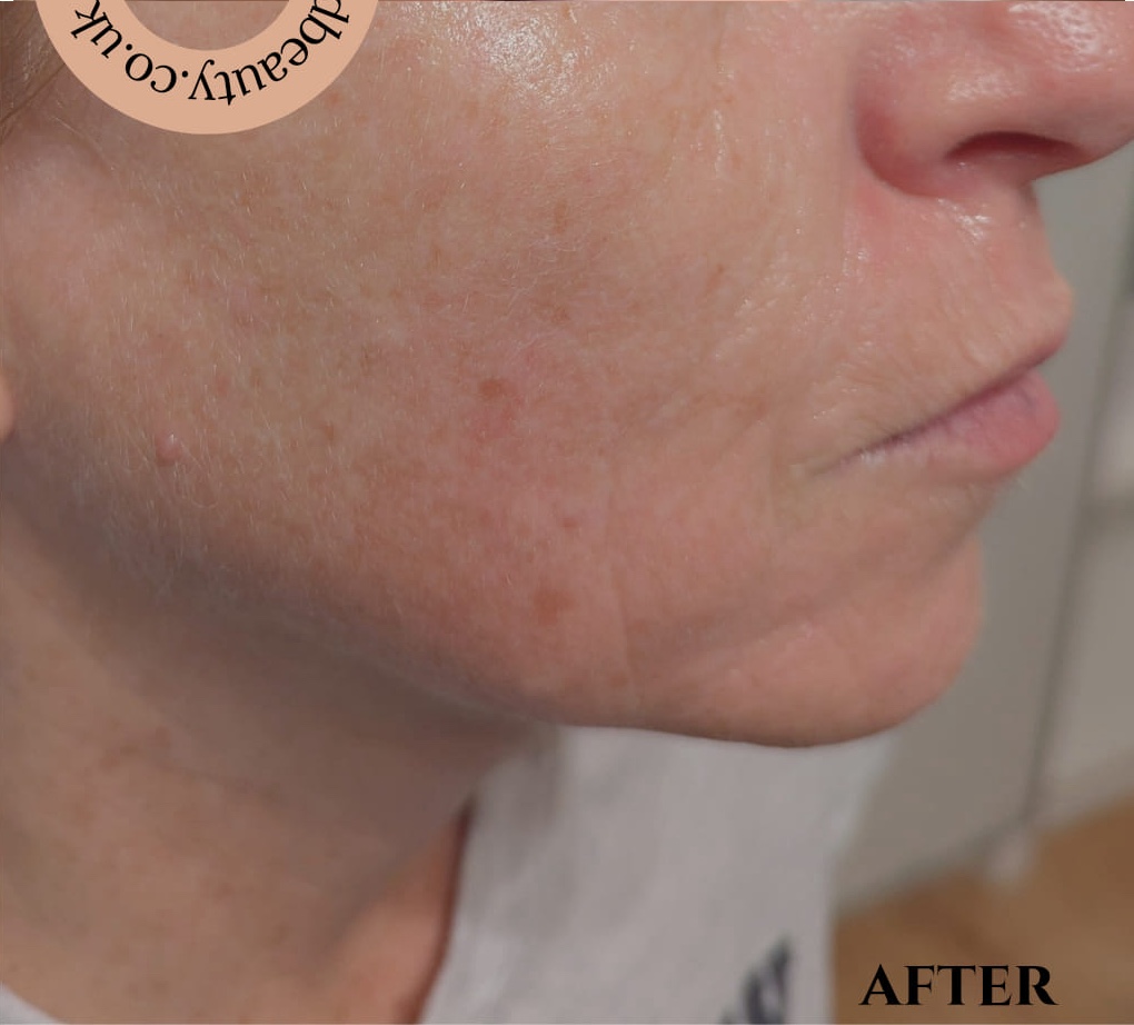 non-surgical radio frequency treatment for sun damaged skin results SkinBase Collagen Lift Gaby Massage and Beauty 2