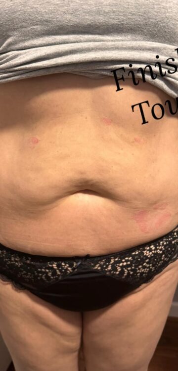 non-surgical radio frequency treatment stomach results SkinBase Finishing Touches Beauty 1