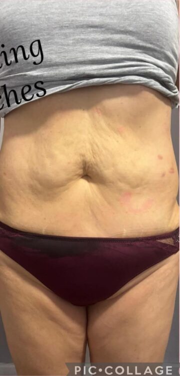 non-surgical radio frequency treatment stomach results SkinBase Finishing Touches Beauty 2