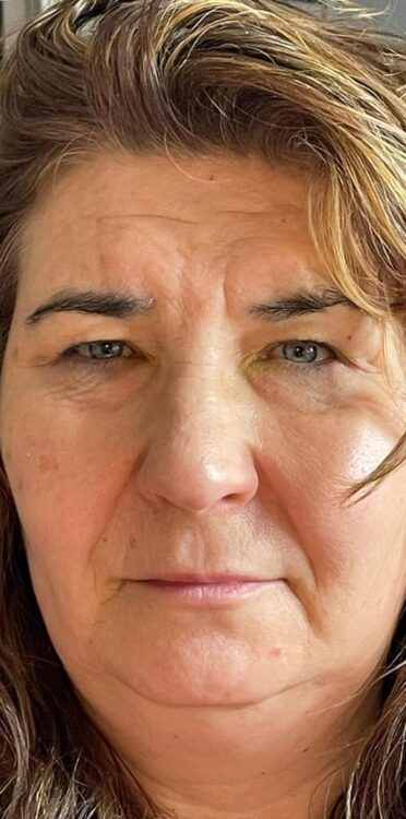 non-surgical skin treatment for dull and textured skin Collagen Lift ULTIMATE Bijou Beauty 1