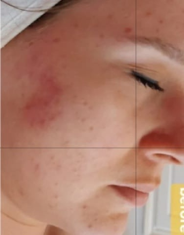 pre wedding breakout treatment before and after SkinBase Microdermabrasion Nails & Beauty by Lisa 1