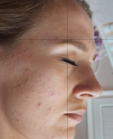 pre wedding breakout treatment before and after SkinBase Microdermabrasion Nails & Beauty by Lisa 1