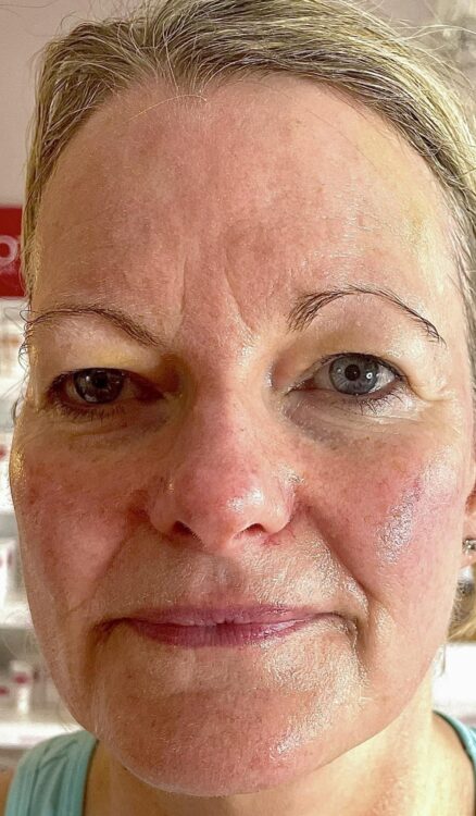 radio frequency for skin laxity results bijou beauty room 1