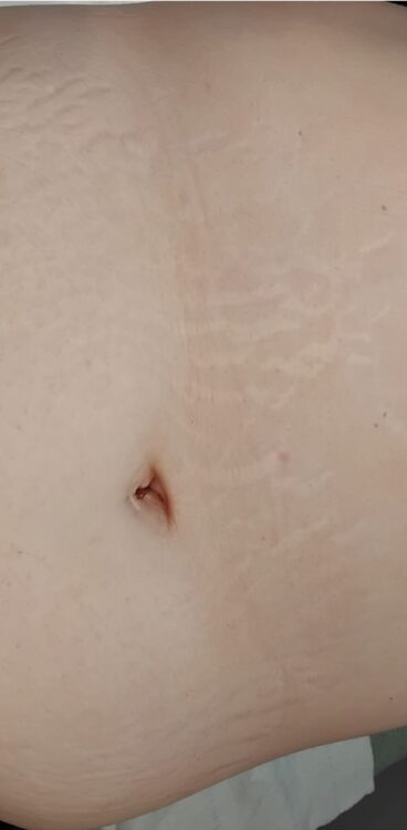 radio frequency non-surgical tummy rejuvenation bliss hair and beauty 2