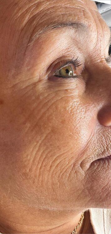 radio-frequency skin smoothing facial results - Primrose Beauty & Aesthetics 1
