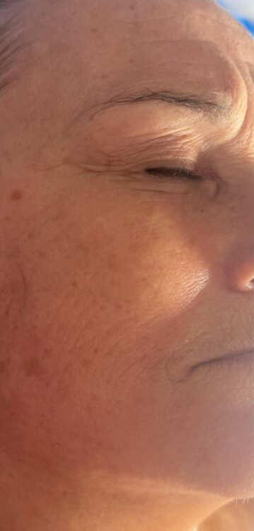 radio-frequency skin smoothing facial results - Primrose Beauty & Aesthetics 2