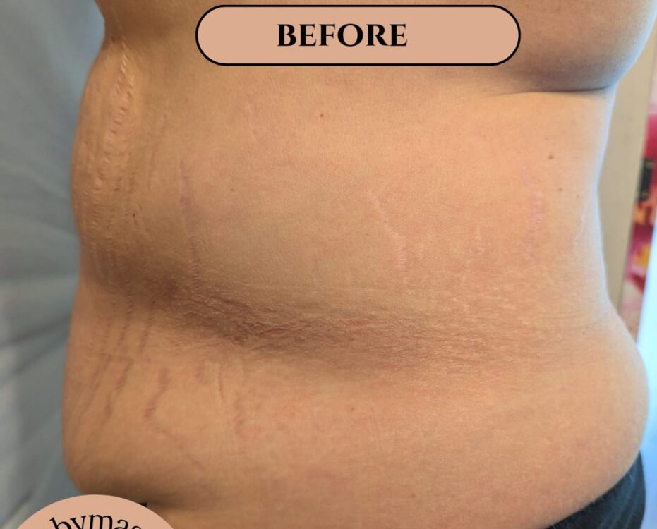 radio frequency tummy transformation results Gaby Massage & Beauty SkinBase Collagen Lift 1