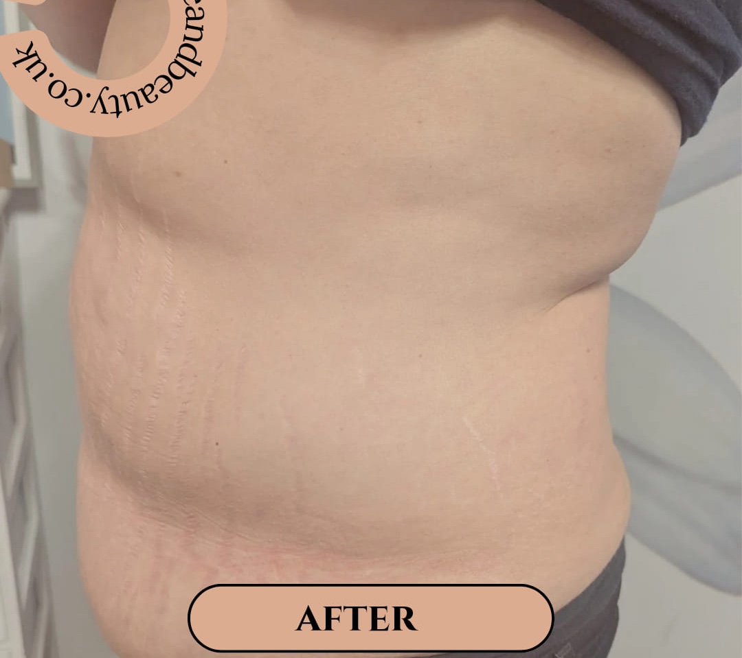 radio frequency tummy transformation results Gaby Massage & Beauty SkinBase Collagen Lift 2