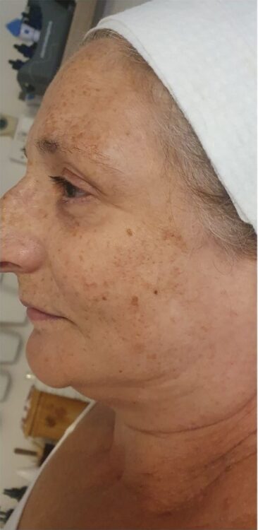 skin firming collagen treatment results SkinBase Anna's Beauty Centre 1