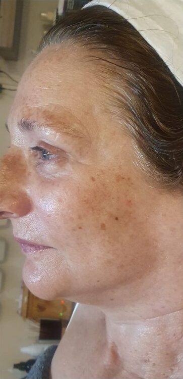 skin firming collagen treatment results SkinBase Anna's Beauty Centre 2