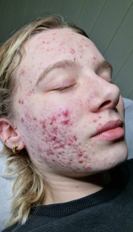 teen acne microdermabrasion facial results SkinBase Jameel Beauty 1