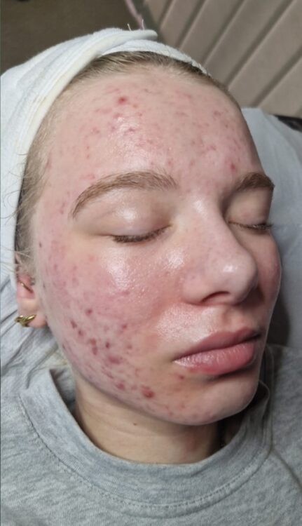 teen acne microdermabrasion facial results SkinBase Jameel Beauty 2